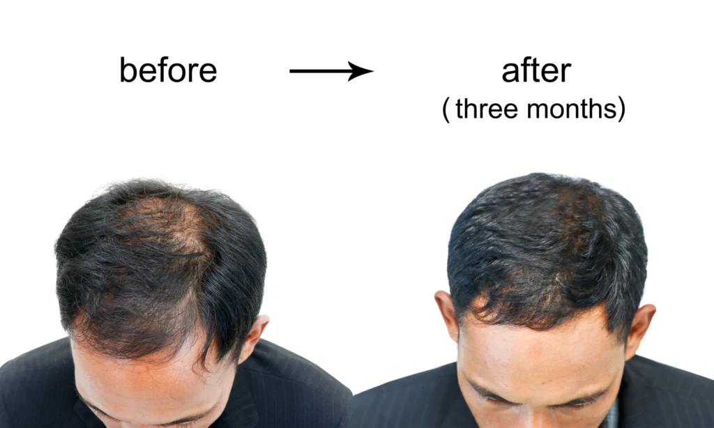 Best PRP Treatment for Alopecia and Hair Regrowth